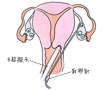 小儿退烧推拿手法 5种南通捐卵宝宝退烧按摩方法